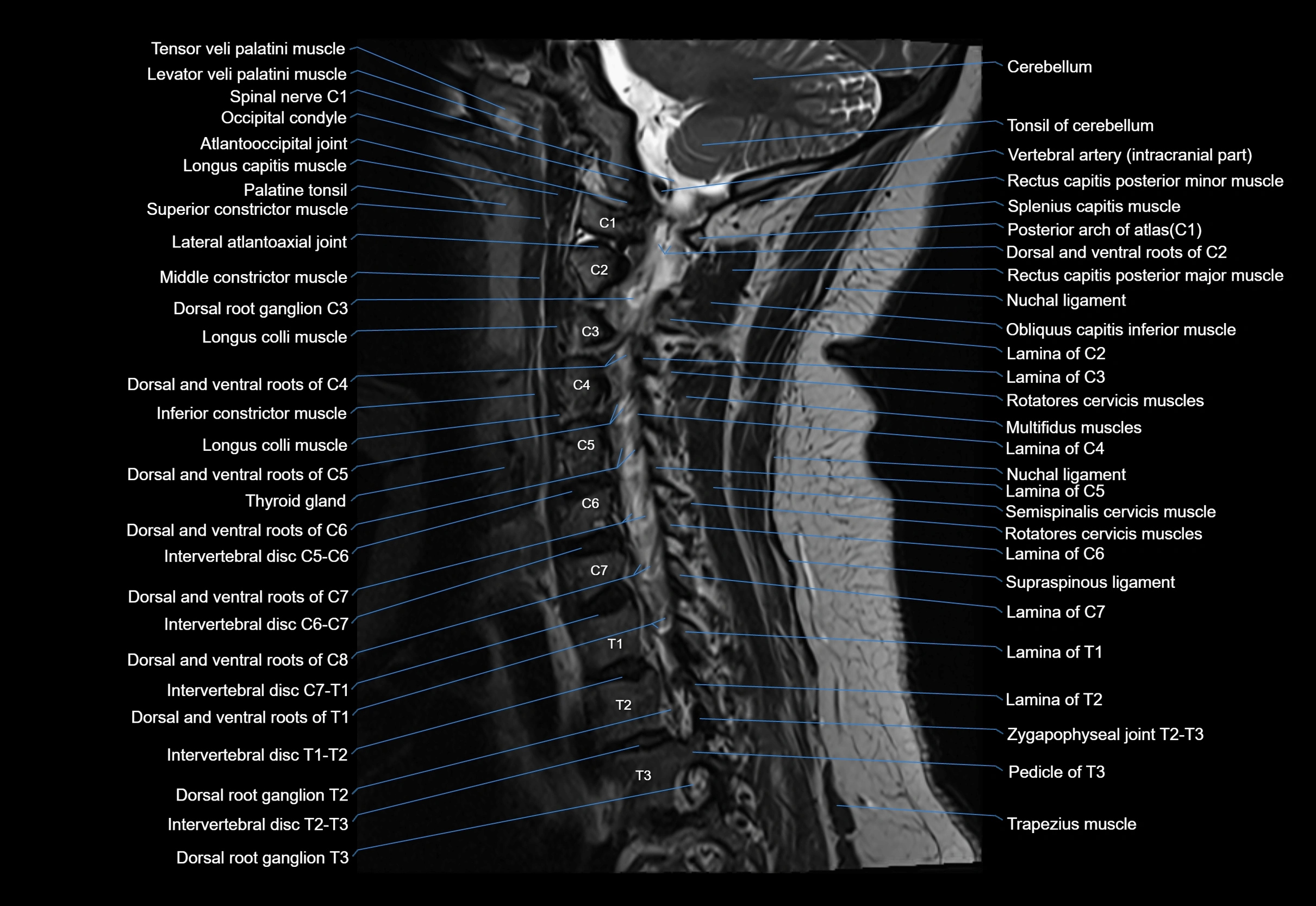 cervical spine cross sectional MRI anatomy 3T MRI  sagittal image-img-00001-00012.webp
